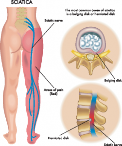 Sciatica Back Pain Denver